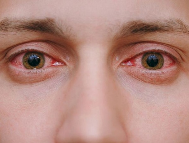 Cómo el calor afecta tus ojos: riesgos y enfermedades frecuentes