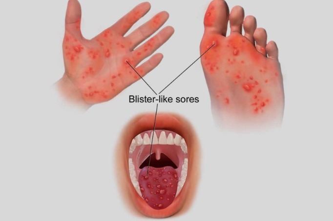 Son 125 casos de niños con la enfermedad de manos, pies y boca en Áncash 