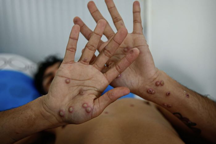 Viruela del mono: OMS la declara nuevamente como emergencia internacional de salud pública