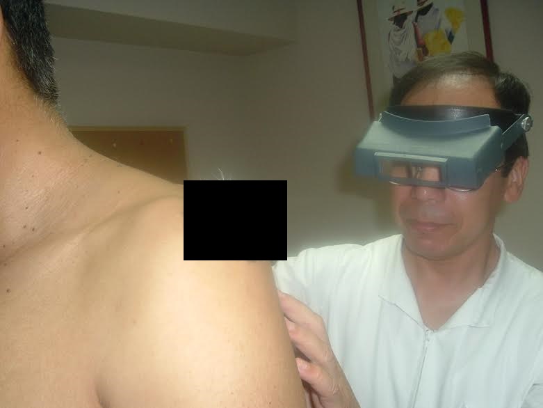 Huaraz: mañana es la campaña nacional de atención y prevención de cáncer a la piel