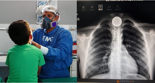 EsSalud de Áncash salva a niño que tenía moneda atorada en el esófago