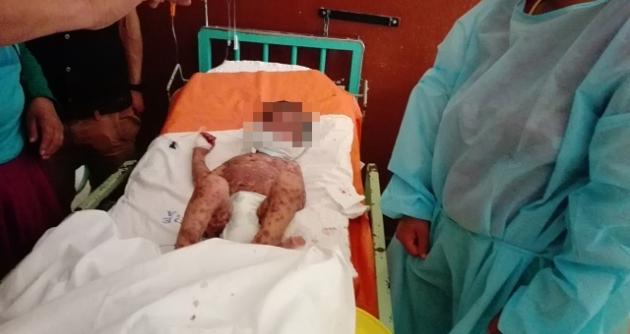 Alerta epidemiológica en Áncash por casos de niños con varicela 