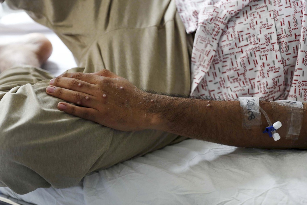 Viruela del mono: ya son 1,590 los casos confirmados en Perú