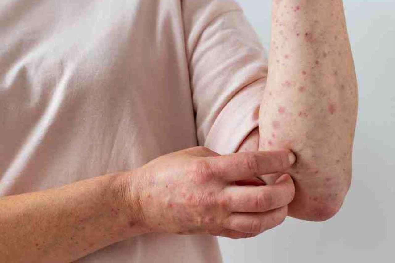 Viruela del mono: confirman primer caso en Arequipa